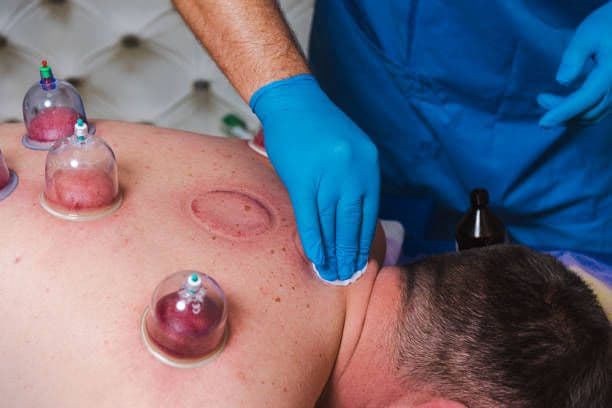 Cupping Therapy