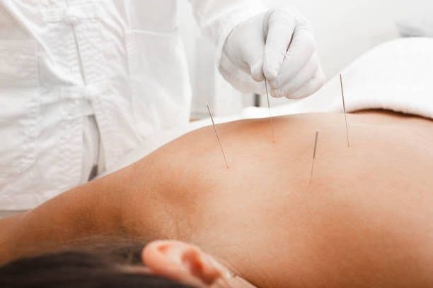 Dry Needling — physiotherapy treatment in Rishikesh