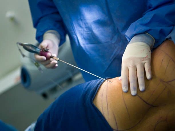 Liposuction Massage Therapy