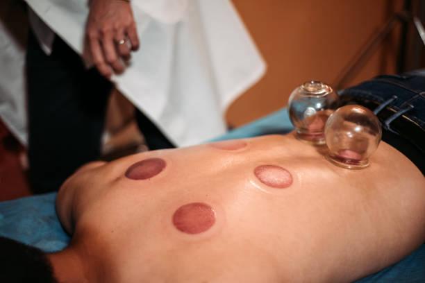 Cupping Therapy Explanation